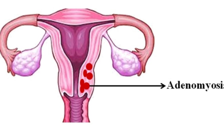 Adenomyozis Nedir? 1 Adenomyozis Nedir? 1